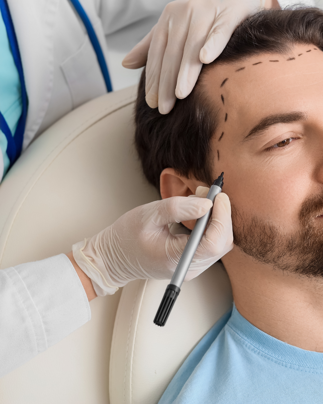 Procedimento Médico de Transplante Capilar e Desenho de Linha Frontal